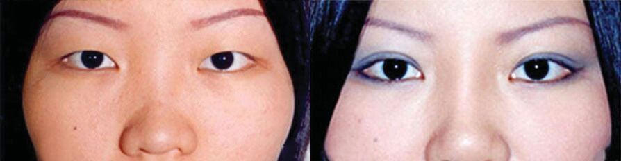 Asian Double Eyelid Before and After Boston, Beverly and New York City