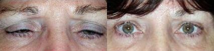 Brow Lift Before and After Photo by Dr. Glavas in Boston Massachusetts