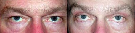 Brow Lift Before and After Photo by Dr. Glavas in Boston Massachusetts