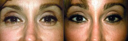 Fillers Before and After Photo by Dr. Glavas in Boston Massachusetts