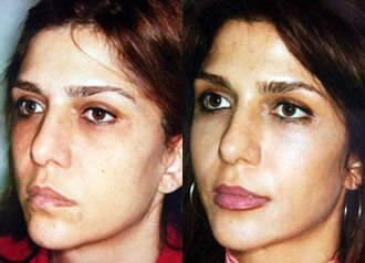 Fillers Before and After Photo by Dr. Glavas in Boston Massachusetts