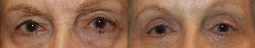 Eye Lift Before and After Photo by Dr. Glavas in Boston Massachusetts