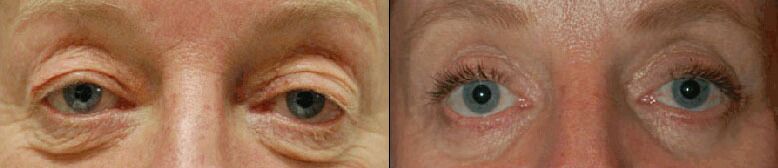 Eye Lift Before and After Photo by Dr. Glavas in Boston Massachusetts