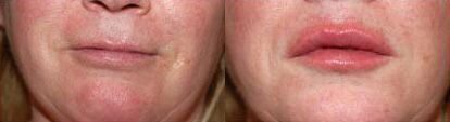 Fillers Before and After Photo by Dr. Glavas in Boston Massachusetts