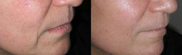 Fillers Before and After Photo by Dr. Glavas in Boston Massachusetts