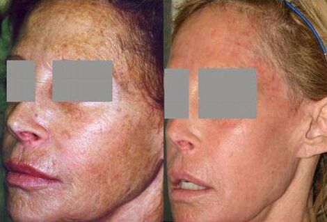 Laser Skin Resurfacing Results Boston