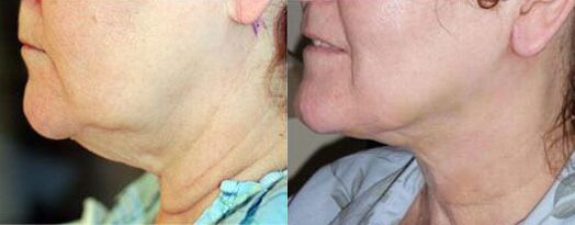 Neck Lift Before and After Photo by Dr. Glavas in Boston Massachusetts