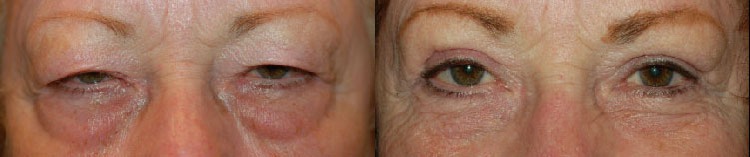 Eye Lift Before and After Photo by Dr. Glavas in Boston Massachusetts