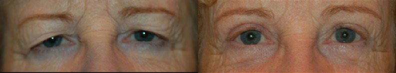 Eye Lift Before and After Photo by Dr. Glavas in Boston Massachusetts