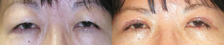 Eye Lift Before and After Photo by Dr. Glavas in Boston Massachusetts