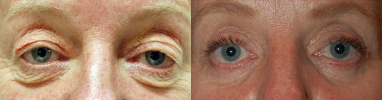 Eye Lift Before and After Photo by Dr. Glavas in Boston Massachusetts