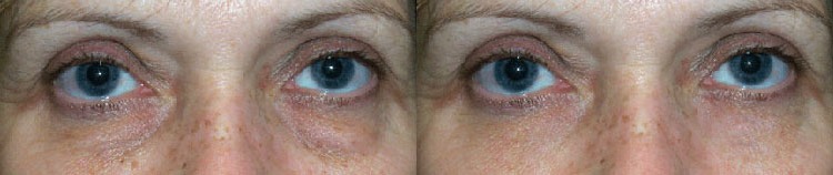 Eye Lift Before and After Photo by Dr. Glavas in Boston Massachusetts