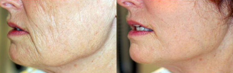 Mid-Face Lift Before and After Photo by Dr. Glavas in Boston Massachusetts