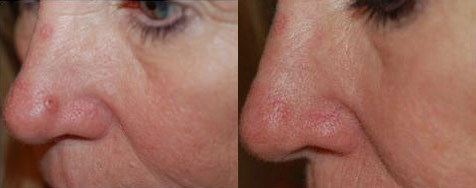 scar-less-mole-removal-bxa2